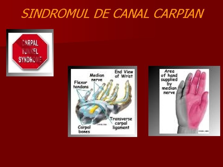 SINDROMUL DE CANAL CARPIAN 