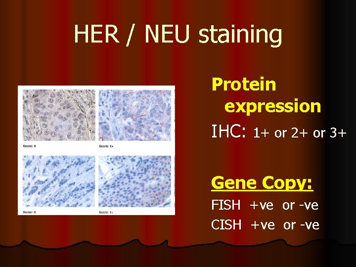 HER / NEU staining Protein expression IHC: 1+ or 2+ or 3+ Gene Copy: