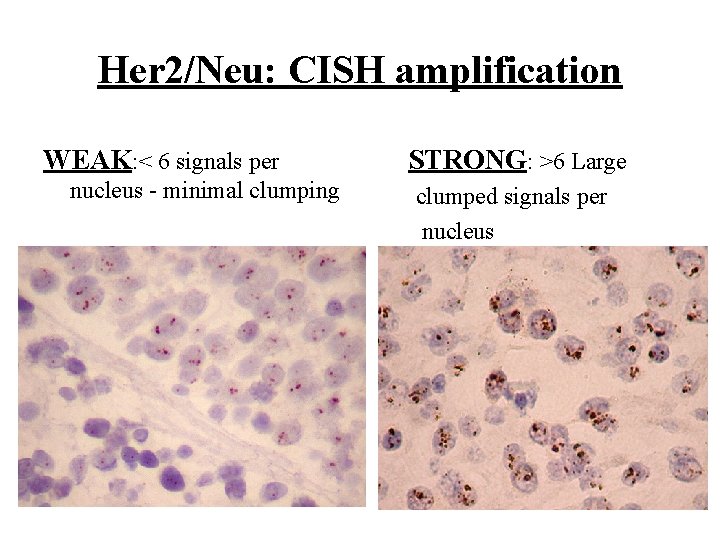 Her 2/Neu: CISH amplification WEAK: < 6 signals per nucleus - minimal clumping STRONG: