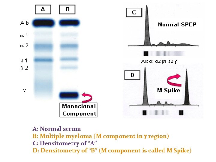A: Normal serum B: Multiple myeloma (M component in g region) C: Densitometry of