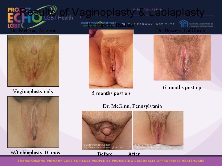 Results of Vaginoplasty & Labiaplasty Dr. Meltzer, Arizona Vaginoplasty only Dr. Suporn, Thailand Dr.