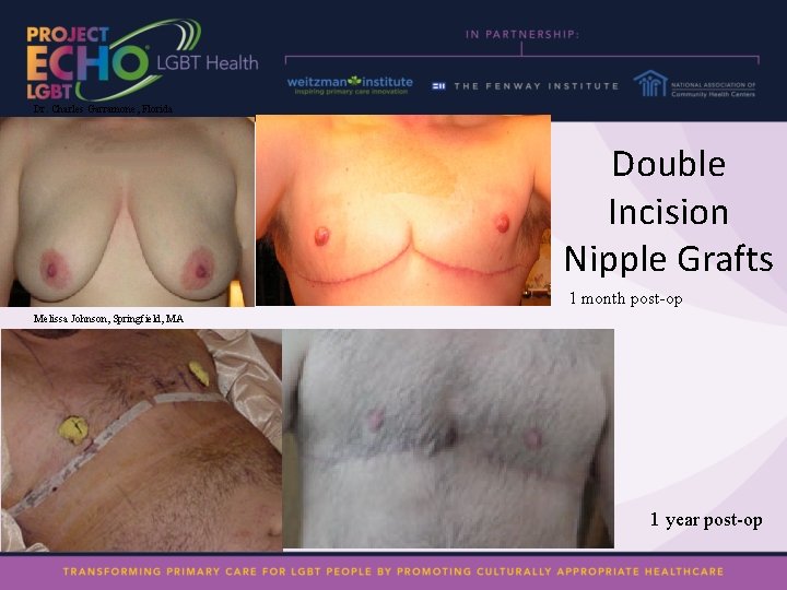 Dr. Charles Garramone, Florida Double Incision Nipple Grafts 1 month post-op Melissa Johnson, Springfield,