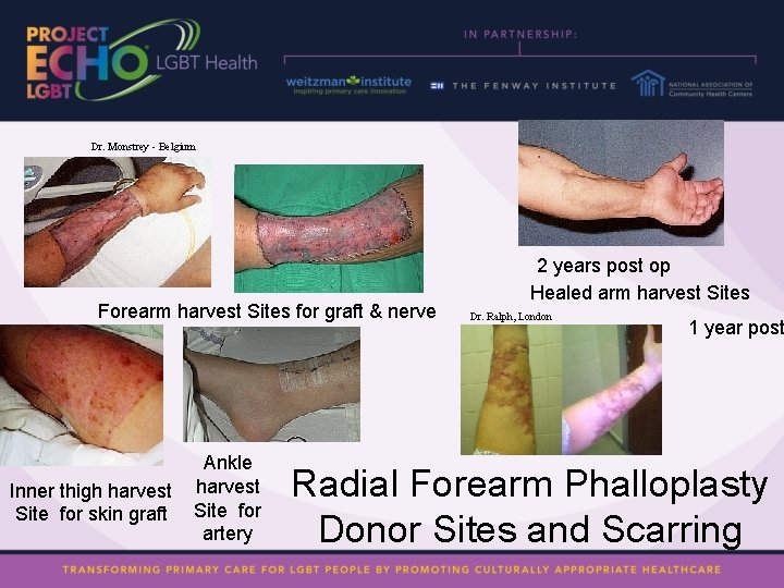 Dr. Monstrey - Belgium Forearm harvest Sites for graft & nerve Inner thigh harvest