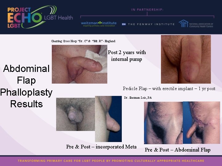 Charring Cross Hosp “Dr. C” & “Mr. R” - England Abdominal Flap Phalloplasty Results