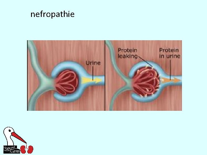 nefropathie 