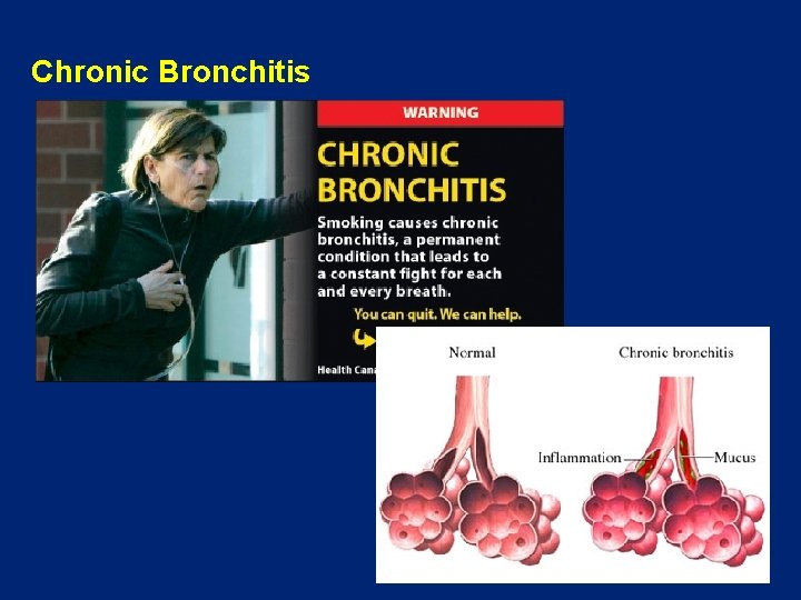 Chronic Bronchitis 