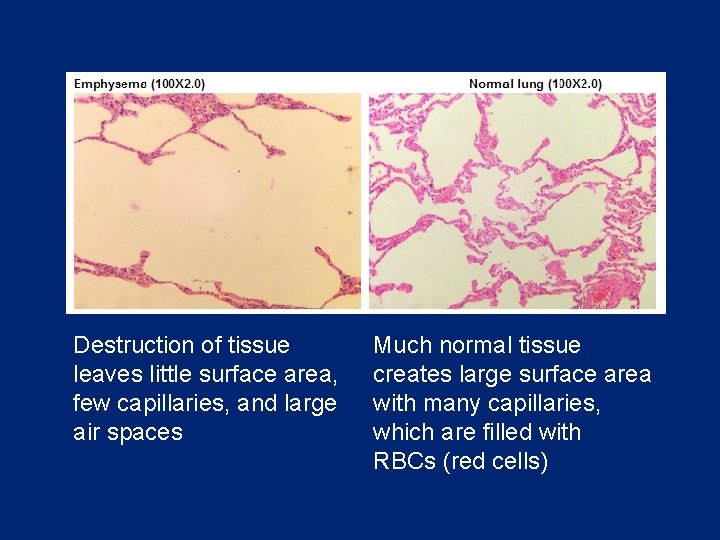 Destruction of tissue leaves little surface area, few capillaries, and large air spaces Much