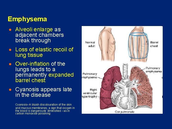 Emphysema · Alveoli enlarge as adjacent chambers break through · Loss of elastic recoil