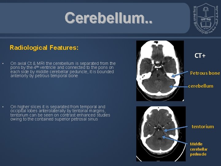Cerebellum. . Radiological Features: • On axial Ct & MRI the cerebellum is separated