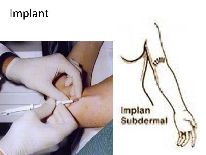 Implant 