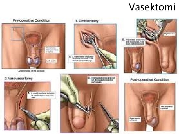 Vasektomi 