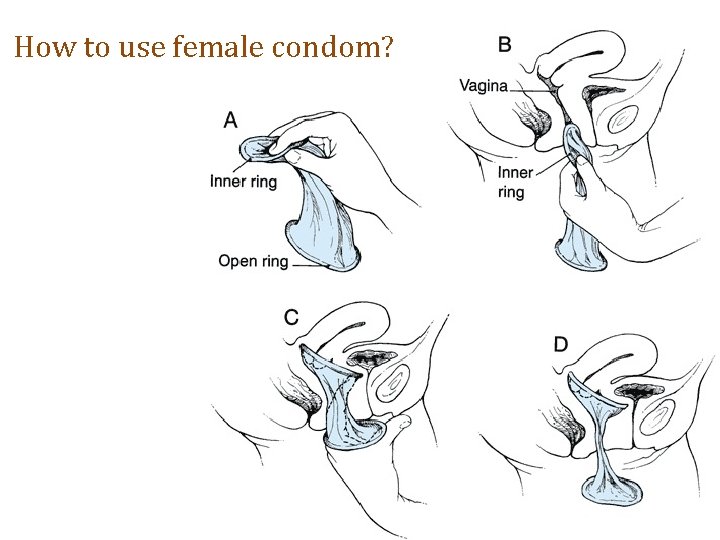 How to use female condom? 