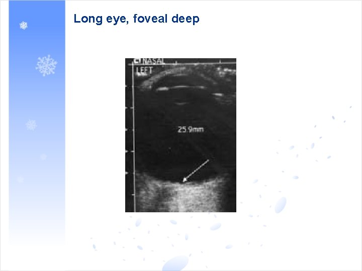 Long eye, foveal deep 