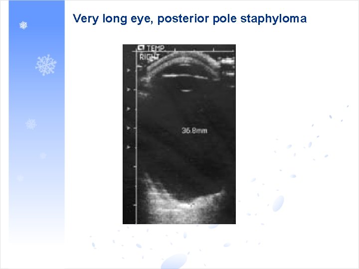 Very long eye, posterior pole staphyloma 