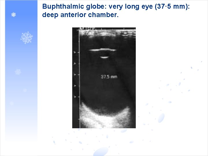 Buphthalmic globe: very long eye (37· 5 mm): deep anterior chamber. 