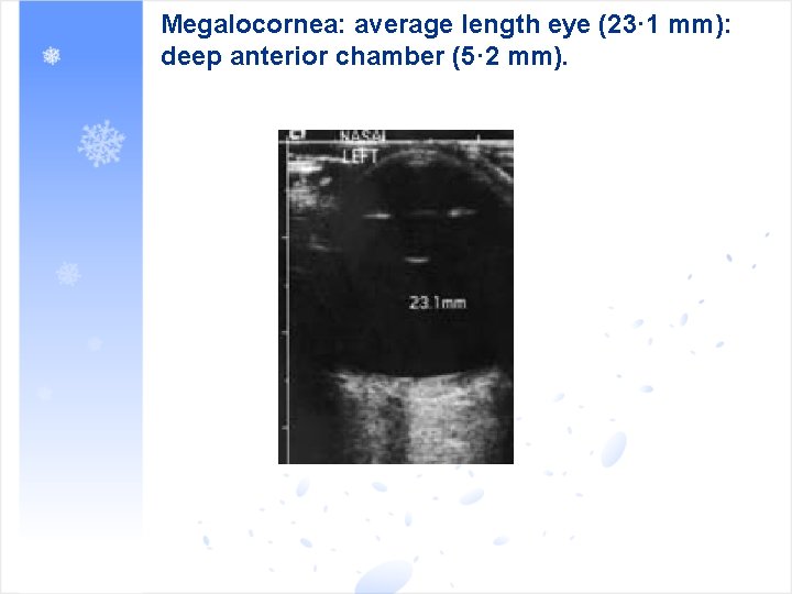 Megalocornea: average length eye (23· 1 mm): deep anterior chamber (5· 2 mm). 