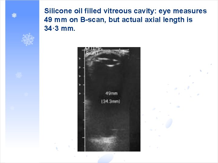 Silicone oil filled vitreous cavity: eye measures 49 mm on B-scan, but actual axial