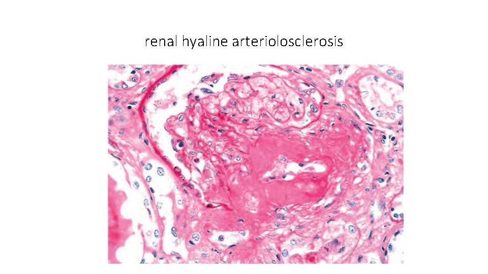 renal hyaline arteriolosclerosis 