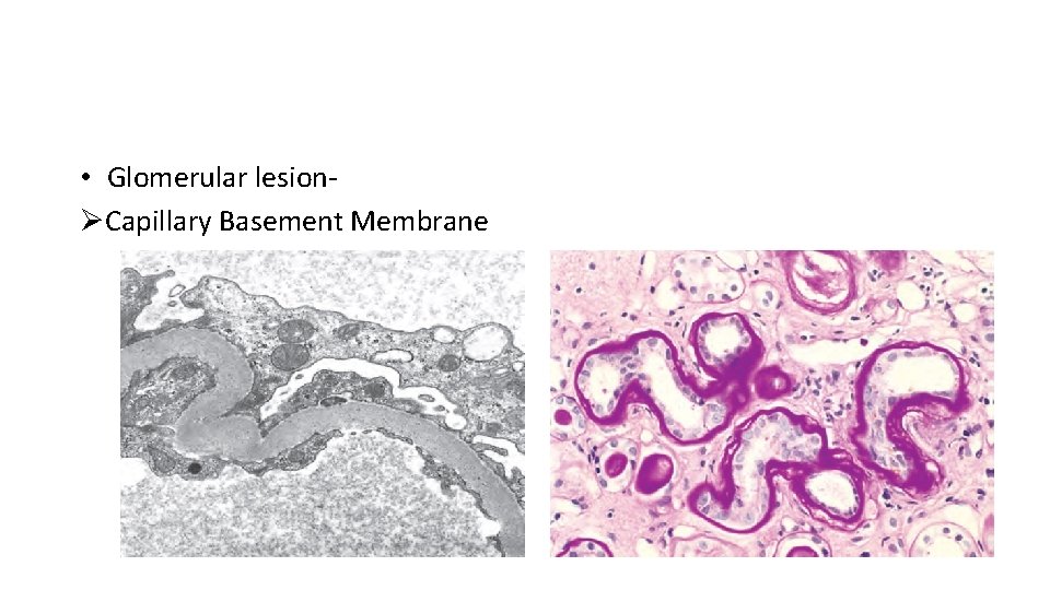  • Glomerular lesionØCapillary Basement Membrane 