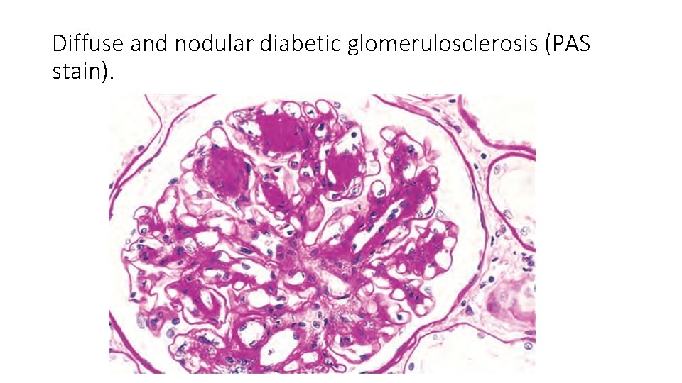 Diffuse and nodular diabetic glomerulosclerosis (PAS stain). 