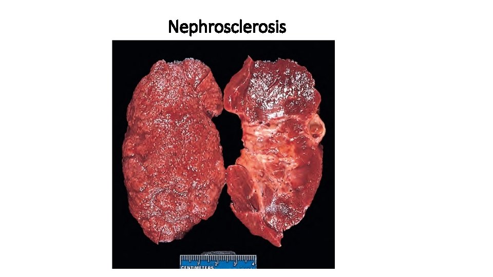 Nephrosclerosis 