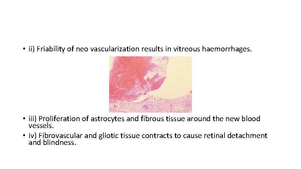  • ii) Friability of neo vascularization results in vitreous haemorrhages. • iii) Proliferation