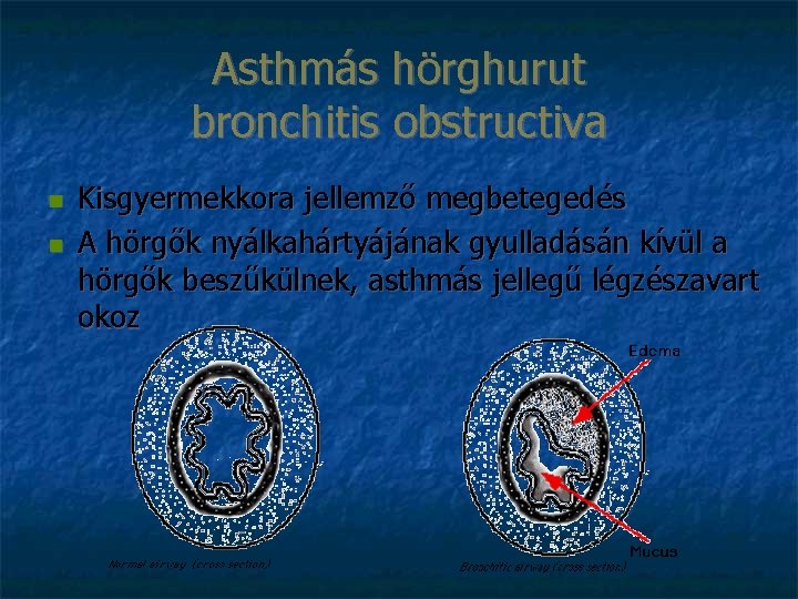 Asthmás hörghurut bronchitis obstructiva Kisgyermekkora jellemző megbetegedés A hörgők nyálkahártyájának gyulladásán kívül a hörgők