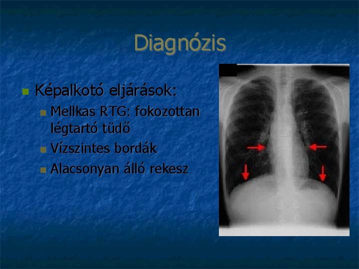 Diagnózis Képalkotó eljárások: Mellkas RTG: fokozottan légtartó tüdő Vízszintes bordák Alacsonyan álló rekesz 