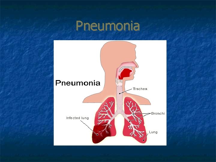 Pneumonia 