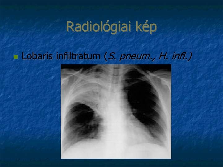 Radiológiai kép Lobaris infiltratum (S. pneum. , H. infl. ) 