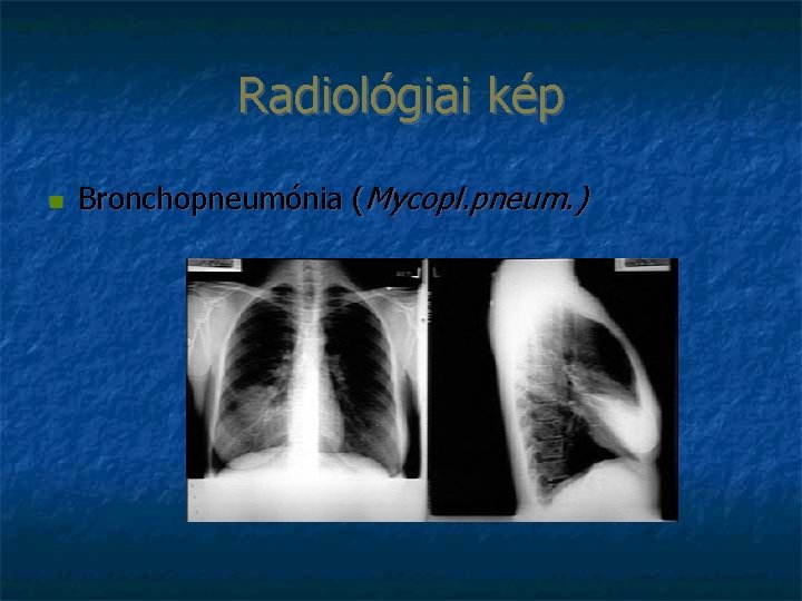 Radiológiai kép Bronchopneumónia (Mycopl. pneum. ) 