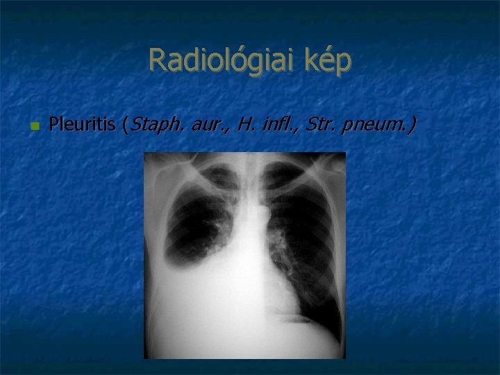 Radiológiai kép Pleuritis (Staph. aur. , H. infl. , Str. pneum. ) 