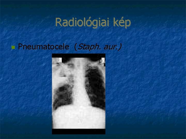 Radiológiai kép Pneumatocele (Staph. aur. ) 