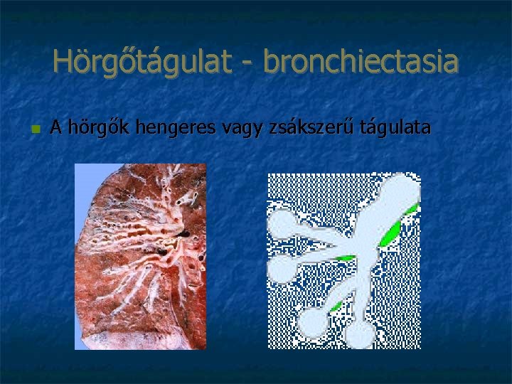 Hörgőtágulat - bronchiectasia A hörgők hengeres vagy zsákszerű tágulata 