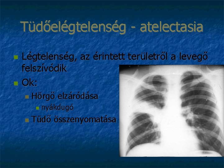 Tüdőelégtelenség - atelectasia Légtelenség, az érintett területről a levegő felszívódik Ok: Hörgő elzáródása nyákdugó