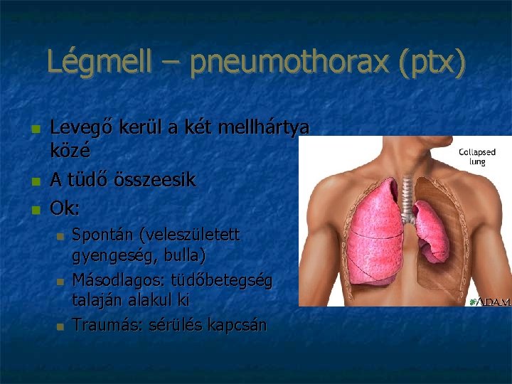 Légmell – pneumothorax (ptx) Levegő kerül a két mellhártya közé A tüdő összeesik Ok: