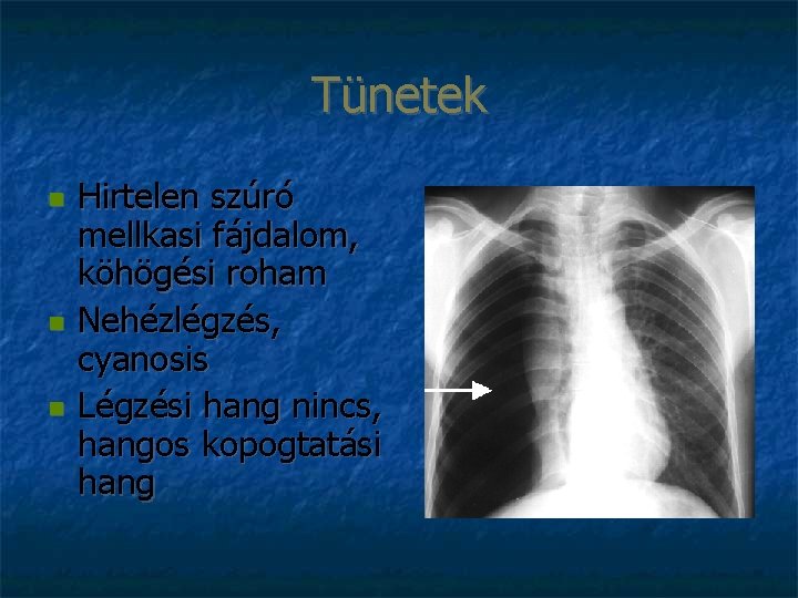 Tünetek Hirtelen szúró mellkasi fájdalom, köhögési roham Nehézlégzés, cyanosis Légzési hang nincs, hangos kopogtatási