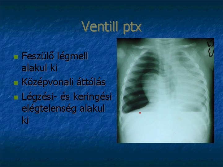 Ventill ptx Feszülő légmell alakul ki Középvonali áttólás Légzési- és keringési elégtelenség alakul ki