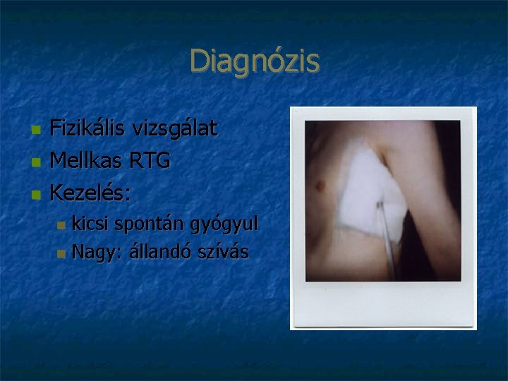 Diagnózis Fizikális vizsgálat Mellkas RTG Kezelés: kicsi spontán gyógyul Nagy: állandó szívás 