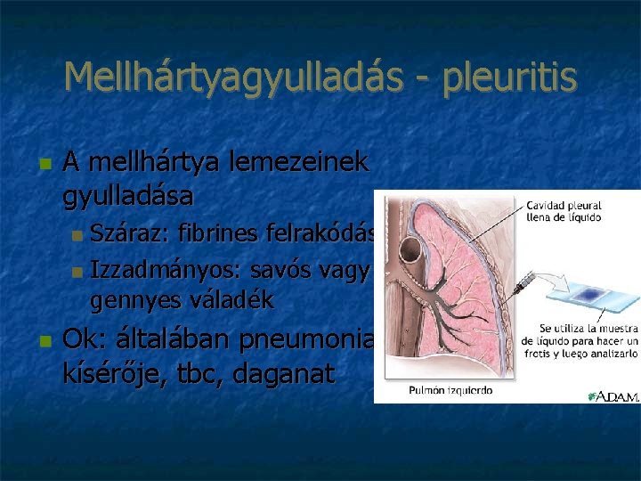 Mellhártyagyulladás - pleuritis A mellhártya lemezeinek gyulladása Száraz: fibrines felrakódás Izzadmányos: savós vagy gennyes