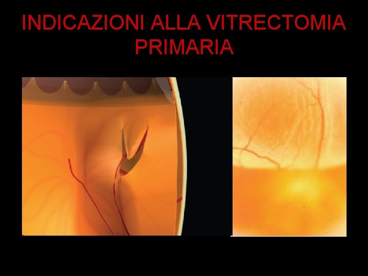 INDICAZIONI ALLA VITRECTOMIA PRIMARIA 