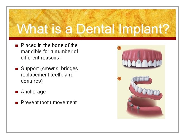 What is a Dental Implant? n Placed in the bone of the mandible for