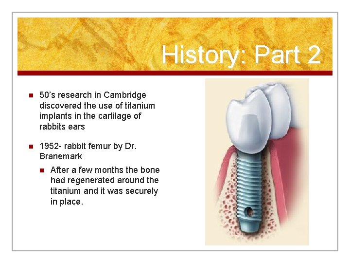 History: Part 2 n 50’s research in Cambridge discovered the use of titanium implants