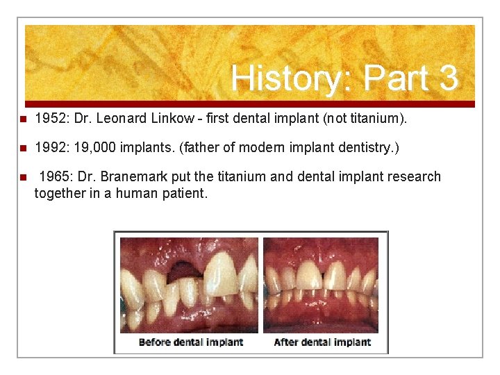 History: Part 3 n 1952: Dr. Leonard Linkow - first dental implant (not titanium).