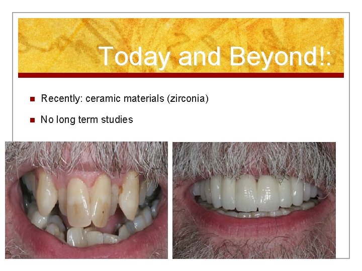 Today and Beyond!: n Recently: ceramic materials (zirconia) n No long term studies 