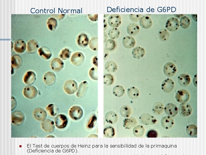 Control Normal n Deficiencia de G 6 PD El Test de cuerpos de Heinz