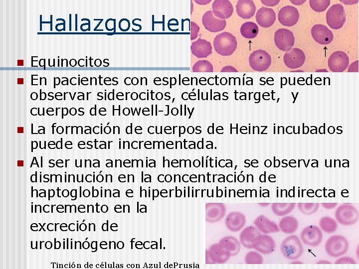 Hallazgos Hematológicos n n Equinocitos En pacientes con esplenectomía se pueden observar siderocitos, células