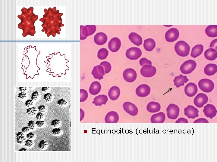 n Equinocitos (célula crenada) 