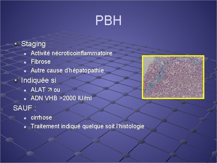 PBH Staging n n n Activité nécroticoinflammatoire Fibrose Autre cause d’hépatopathie Indiquée si n