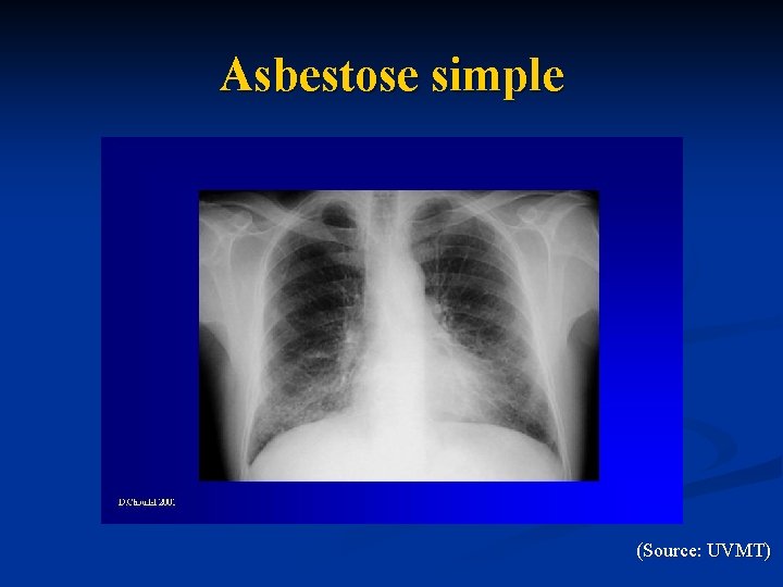 Asbestose simple (Source: UVMT) 